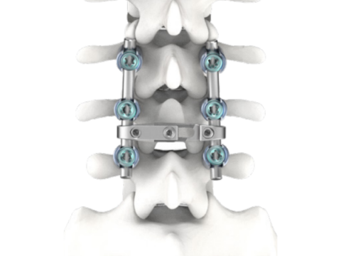 Chiron Spinal Fixation System